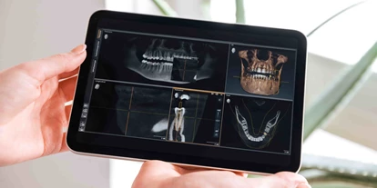Praxen - Implantate: Zahnkrone - 3D-Implantologie  - Zahnarztpraxis am Zeugplatz - Zahnarzt Augsburg